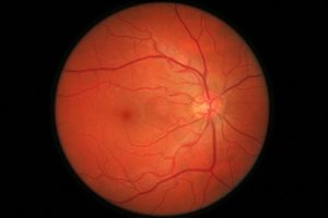 diabetes retinopathy
