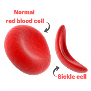 Sickle Cell - Warrior's Health Guide